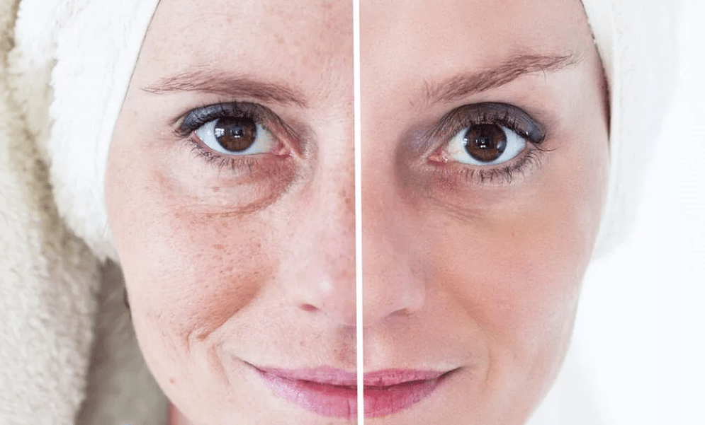 лазерно подмладяване на лицето